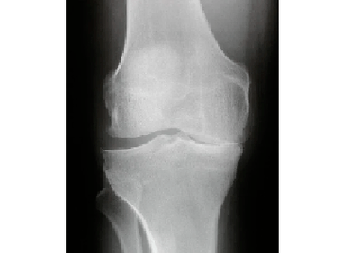 A térdízület ízületi ízületi diagnosztizálása