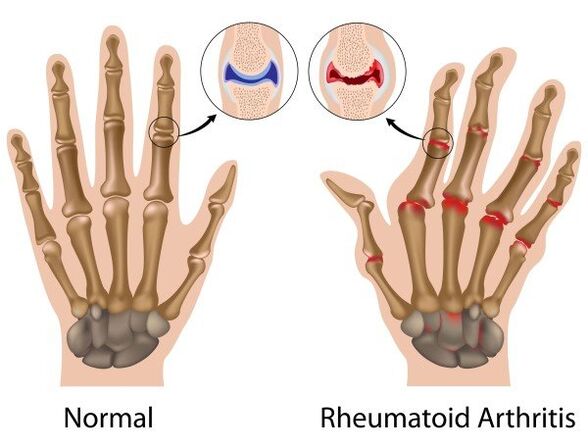 Ujjak ízületei patológia nélkül és rheumatoid arthritis