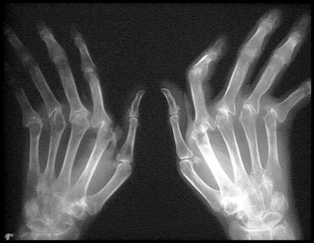 X -Arthrosis által érintett kezek képe