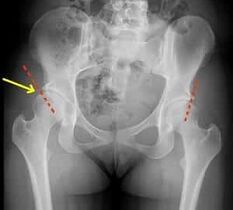 A csípőízület arthrosis kezelésére szolgáló módszerek