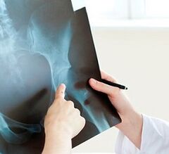 Hogyan kell kezelni a csípőízület arthross -t