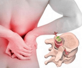 Lumbago a betegség elején az osteochondrosis