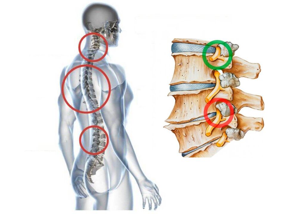 Hogyan néz ki a csigolyák nyaki osteochondrosis