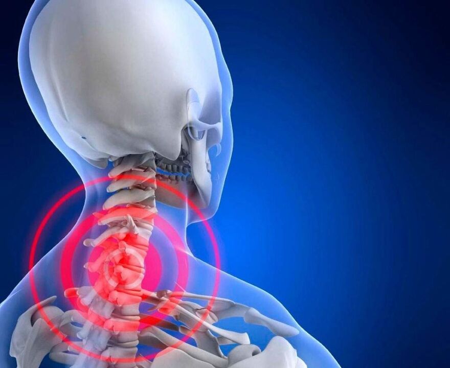nyakfájdalom méhnyak osteochondrosissal