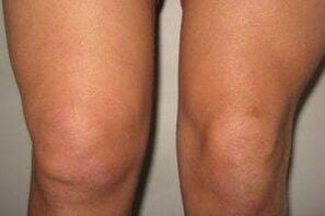 gyulladás a térdízületben ízületi gyulladással és arthrosissal
