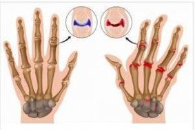 különbségek az ízületi gyulladás és a kezek arthrosis között