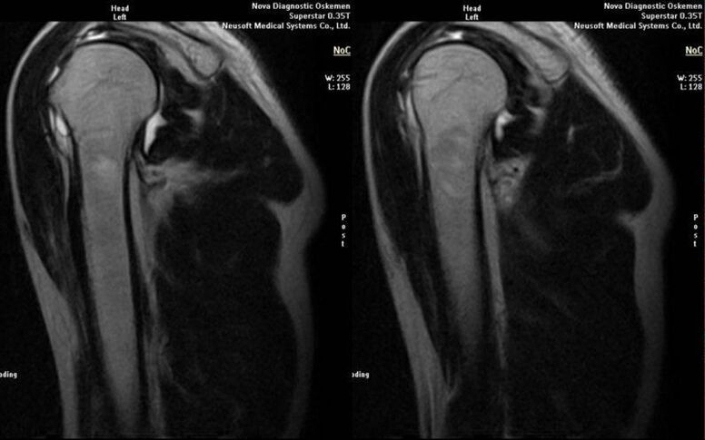 a vállízület arthrosisa röntgenfelvételen