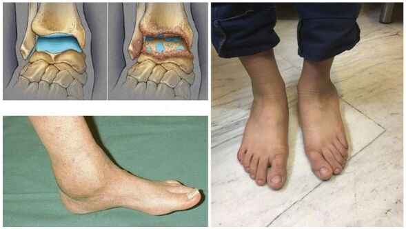 A bokaízület duzzanata és deformációja arthrosis miatt